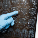 Diabetes Drugs Could Treat Alzheimer’s Symptoms with Timing Key