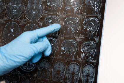Diabetes Drugs Could Treat Alzheimer’s Symptoms with Timing Key